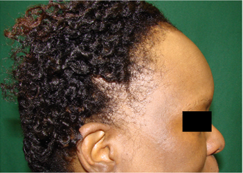 Frontal Fibrosing Alopecia and Concomitant Lichen Planus Pigmentosus: A Case Series of Seven African American Women