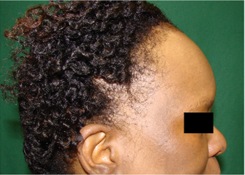 alopecia lichen Planus pigmentosus