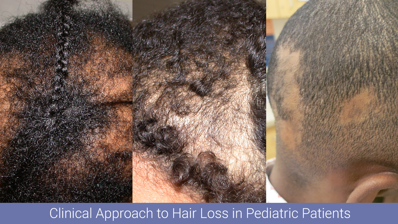 Clinical Approach to Hair Loss in Pediatric Patients