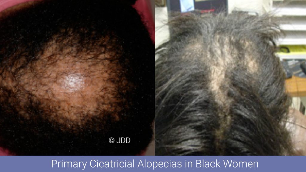 reading treatment skin from Alopecias Black Women Cicatricial Primary Pearls in