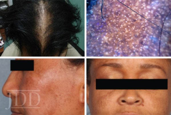Medical Updates in Skin of Color