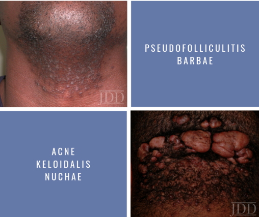 Acne Keloidalis Nuchae