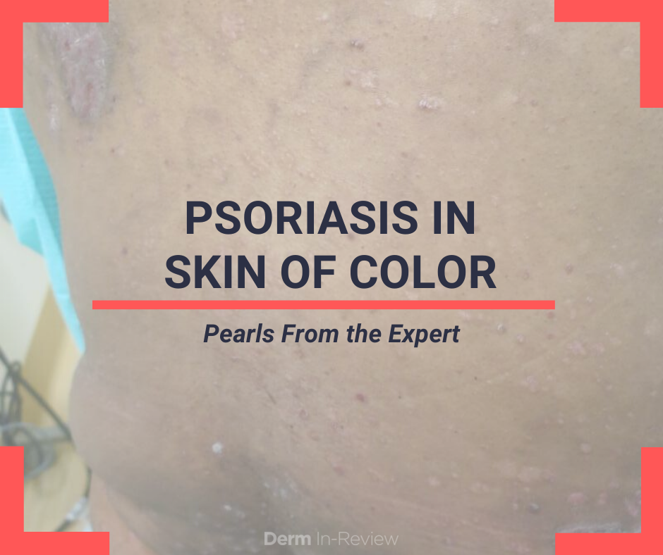 Skin of Color in Psoriasis Pearls from SOC Update