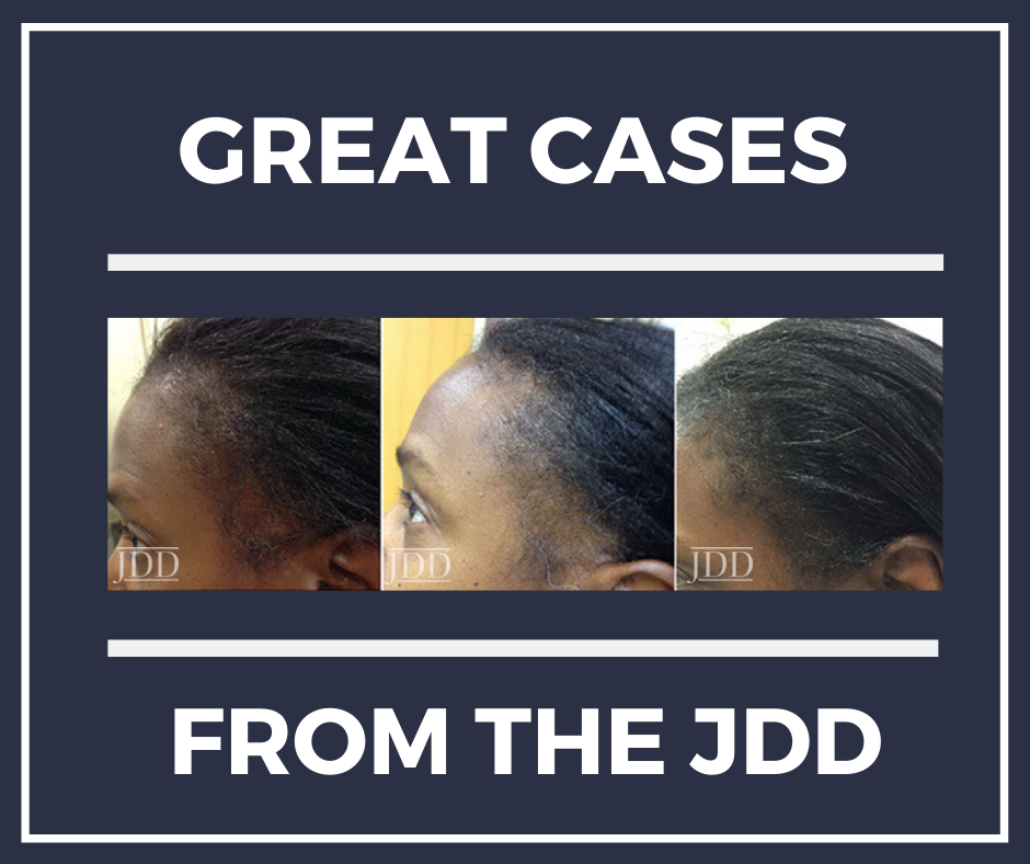 Patient with Alopecia