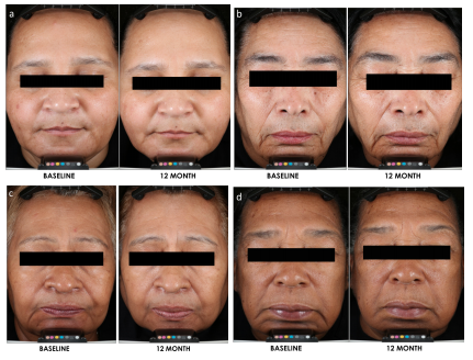 sunscreen ageing