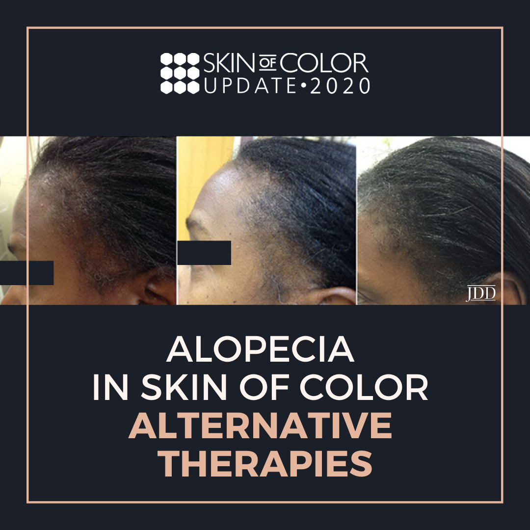 Alopecia in Skin of Color Dermatology Conference