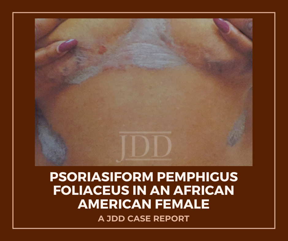 Psoriasiform Pemphigus Foliaceus in an African American Female: An Important Clinical Manifestation