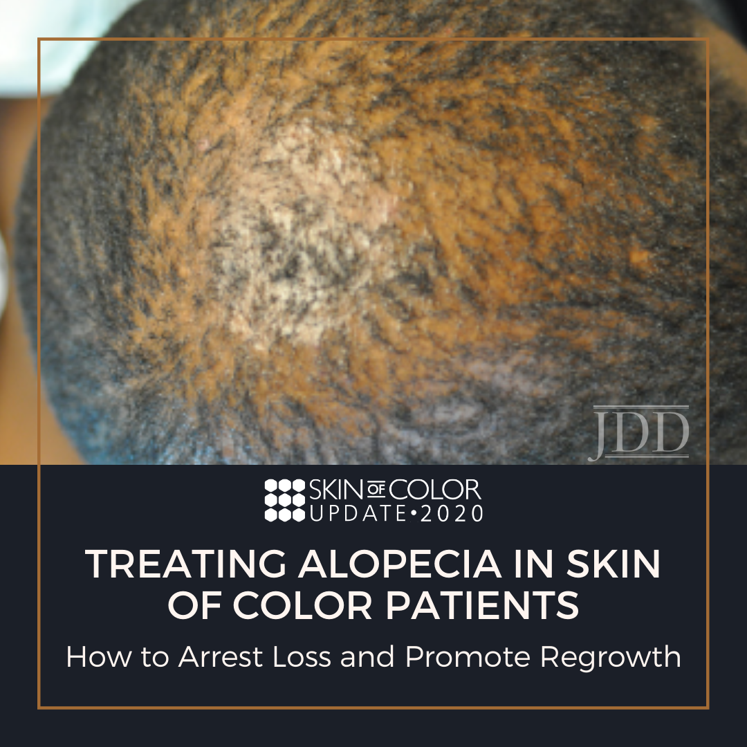 Treating Alopecia in Skin of Color Patients