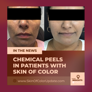 chemical peels