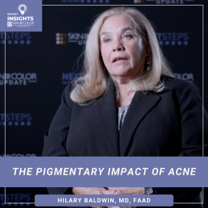 pigmentary impact of acne