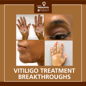 vitiligo treatment