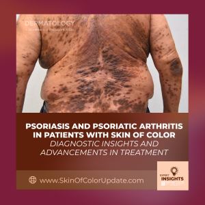 psoriasis in skin of color