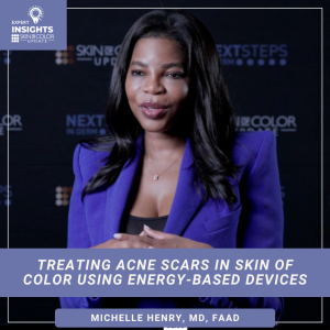 acne scar treatments