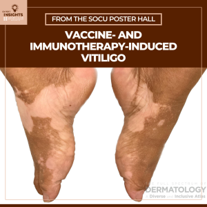 immunotherapy-induced vitiligo